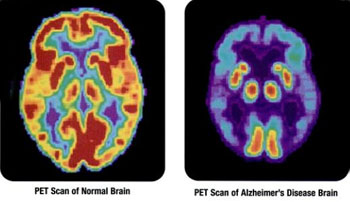 Image: PET scans showing the differences between a normal older adult\'s brain and the brain of an older adult afflicted with Alzheimer\'s disease (Photo courtesy of the NIH).