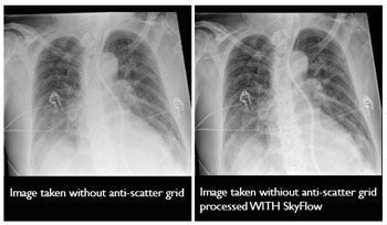 Image: SkyFlow offers a novel technology that combines the ease of a gridless acquisition workflow with contrast like a grid image. Results include superb image quality with less handling (Photo courtesy of Philips Healthcare).