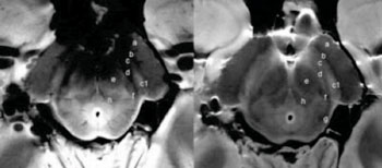 Image: axial spin-echo proton density (on the right) and GRE (on the left) of the substantia nigra (SN) at level I of an ex vivo brain sample in a 67-year-old woman. There is a triple-layered organization of the SN comparable to that showed in the in vivo images. Ventrally a low-signal-intensity layer (b) is attributable to the pars reticulata of the SN. In the middle part of the SN, a hyperintense band (c) corresponds to the ventral component of the pars compacta of the SN. The lateral part of this layer shows a high-signal intensity spot (c1) corresponding to the oval shape hyperintensity of the in vivo 3D multiecho susceptibility-weighted images that resemble the nigrosome formation. The dorsal hypointense layer visible on both spin-echo and GRE images (d) is referred to the dorsal component of the pars compacta of the SN. a = crus cerebri, e = brachjum conjunctivum, f = medial lemniscus, g = lateral lemniscus, h = central tegmental tract (Photo courtesy of the Radiological Society of North America).