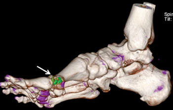 Image: Monosodium urate deposits detected via DECT (Photo courtesy of the Mayo Clinic).