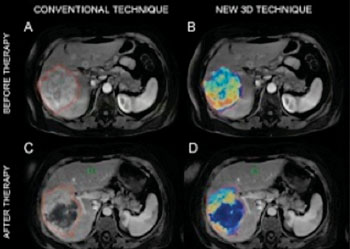 Image: The quantitative character of the novel 3D technique on MR scans from a patient with primary liver cancer is demonstrated. Images A and B show the scan of the patient before being treated with chemoembolization. The new 3D technique helped quantify the volume and distribution of viable tumor tissue (shown in red and yellow colors). Images C and D demonstrate MR scans acquired after the treatment. The new 3D method helped the radiologists to quantify the vast central destruction of the tumor after the treatment (the dead tumor is represented by the blue color) (Photo courtesy of Johns Hopkins Medicine).