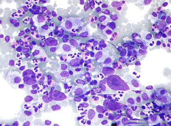 Image: Micrograph of Hodgkin lymphoma. Lymph node fine-needle aspiration (FNA) specimen. Field stain (Photo courtesy of Wikimedia Commons).