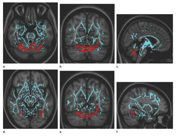 Image: Vestibular disturbances correlate with decreased FA in cerebellar regions responsible for sensorimotor processing and central and/or axial balance as well as fusiform gyrus, which is responsible for visually guided locomotion and stereoscopic vision. Images derived from TBSS results and rendered on T1- weighted images from Montreal Neurologic Institute atlas indicate that significant white matter differences in patients with mild TBI and vestibular symptoms involve (a–c) lobule VI and vermian lobules VIIIa, VIIIb, and IX, as shown in axial (a), coronal (b), and sagittal (c) planes, and (d–f) fusiform gyri bilaterally, as shown in axial (d), coronal (e), and sagittal (f) planes. Significant voxels (p < .005, corrected for multiple comparisons) were thickened by using TBSS fill function into local tracts (red) and overlaid on white matter skeleton (blue) (Photo courtesy of Radiology).