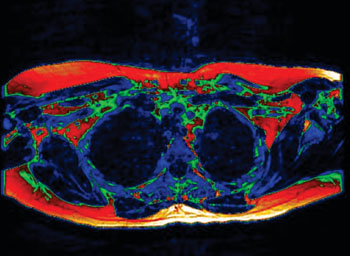 Image: The first MRI scan to show “brown fat” in a living adult could prove to be an essential step towards a new wave of therapies to aid the fight against diabetes and obesity (Photo courtesy of Warwick Medical School).