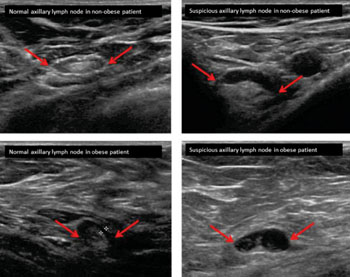 Image: Ultrasound imaging used to identify breast cancer in underarm lymph nodes in obese women has generated an unexpected finding: Fat did not obscure the images, and ultrasound imaging showing no suspicious lymph nodes actually was shown to be more accurate in overweight and obese patients than in women with a normal body mass index (Photo courtesy of the Mayo Clinic).