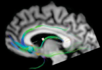 Image: A study using MRI analysis of the white matter connections examined the architecture of this network in patients who demonstrated significant response to subcallosal cingulate deep-brain stimulation (Photo courtesy of Woodruff Health Sciences Center, Emory University).