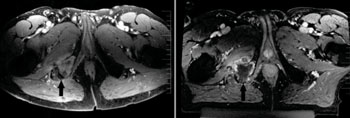 Image: Day of treatment pre- and post-procedure MR imaging. Axial T1-weighted contrast-enhanced MR images demonstrating a right ischial metastasis (black arrow) before treatment (left) and immediately after magnetic resonance-guided focused ultrasound surgery (MRgFUS) treatment (right). The post-treatment image shows nonenhancement of the lesion, which was targeted from a posterior approach. Each hash mark on the scale bars represents 1 cm (Photo courtesy of Journal of the US National Cancer Institute (JNCI)).