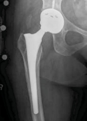 Image: Metal-on-metal (MoM) hip implant (Photo courtesy of the US Drug Watchdog).