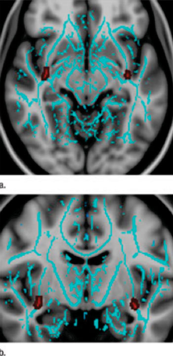 Image: Uncinate fasiculus, an important tract with the greatest concentration of progesterone receptors, show greater injury in males than females after mild traumatic brain injury (mTBI). (a) Axial and (b) coronal images show regions of decreased fractional anisotropy in male patients with mTBI relative to female mTBI patients, involving the uncinate fasiculus (red) bilaterally (Photo courtesy of Radiology).