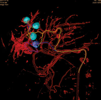 Image: EmboGuide 3D live image guidance tool to see, reach, and treat tumor lesions (Photo courtesy of Philips Healthcare).