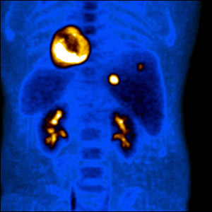 Image: Colorectal cancer showing metastatic disease to the liver on FDG PET imaging. The heart shows the most FDG uptake (normal). Just below and to the right are two foci of increased FDG uptake showing cancer in the liver (Photo courtesy of Johns Hopkins Medicine).