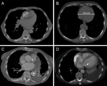 Image: Examples of cardiovascular chest CT findings. Ascending thoracic aorta diameter measurement (A). Cardiac diameter measurement (B). Calcifications in the left anterior descending coronary artery and the descending thoracic aorta (C). Calcifications on the mitral valve (D) (Photo courtesy of the Radiological Society of North America).