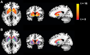 Image: Basal ganglia activation in the gambling task. Left to right: Axial, coronal, and transverse sections of the brain. The top row displays the activation for the Win-Lose contrast, for the pooled sample of chronic fatigue syndrome (CFS)+control subjects, as a statistical parametric map thresholded at a p < 0.05 corrected threshold and masked with the atlas-based anatomic regions of interest portrayed in the bottom row (putamen: purple; caudate: orange; globus pallidus: turquoise) (Photo courtesy of Plos one).