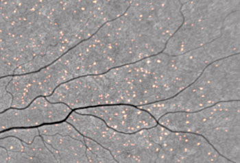 Image: Amyloid plaques showing up in retinal scan as fluorescent spots as curcumin binds to them (Photo courtesy of CSIRO).