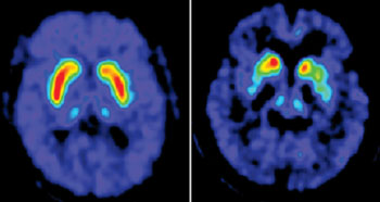 Image: PET scans highlight the loss of dopamine storage capacity in Parkinson’s disease. In the scan of a disease-free brain, made with [18F]-FDOPA PET (left image), the red and yellow areas show the dopamine concentration in a normal putamen, a part of the mid-brain. Compared with that scan, a similar scan of a Parkinson’s patient (right image) shows a marked dopamine deficiency in the putamen (Photo courtesy of the Feinstein Institute’s Center for Neurosciences).