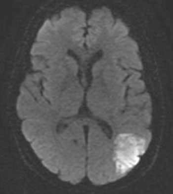 Image: The ischemic penumbra is visible in some patients up to 24 hour after stroke by MRI scanning. Perfusion-weighted imaging can be used to show areas of ischemia and can be compared with the ischemic core, visible by diffusion-weighted imaging (Photo courtesy of sharinginginhealth dot ca, an open access training in healthcare resource).