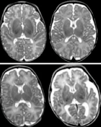 Image: In a preterm infant’s brain, an MRI scan can reveal abnormalities that were undetected by previous methods. The scans on the left show normal gray matter, while those on the right show abnormal gray matter (Photo courtesy of Washington University in St. Louis).
