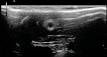 Image: Ultrasound image of the morphology of a chitosan nerve conduit in a rat model of sciatic nerve defects at three weeks after modeling (Photo courtesy of Neural Regeneration Research journal).