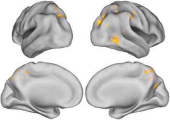 Image: Scans that represent all subjects with beta-amyloid deposits in their brain. The yellow and orange colors show areas where greater brain activation was associated with the formation of more detailed memories (Photo courtesy of Jagust Lab.)