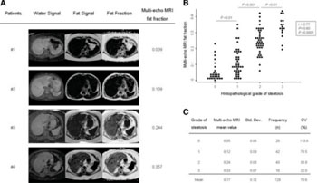 Image: Multi-echo MRI fat fractions positively correlate with the grade of steatosis estimated by histopathologic measurements. (A) Representative multi-echo MRI images showing different degrees of water and fat intensity, and fat fraction in different patients. (B) Multi-echo MRI fat fractions positively correlate with the grade of steatosis estimated by histopathologic measurements in human livers (n =129). Dots represent the values of each case. (C) Multi-echo MRI fat fraction mean values of each steatosis grading group (0 to 3 scale). CV, coefficient of variation; MRI, magnetic resonance imaging; Std. Dev, standard deviation (Photo courtesy of Jiménez-Agüero, et al: BMC Medicine 2014 12:137).