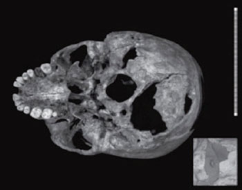 Image: Inferior aspect of the skull; digital photograph with a micro-CT inset of the penetrating injury, with associated inner table injury (arrow). Scale in mm; a = large sharp-force trauma with bone fragment that could be refitted for imaging; b = penetrating injury (Photo courtesy of the Lancet).