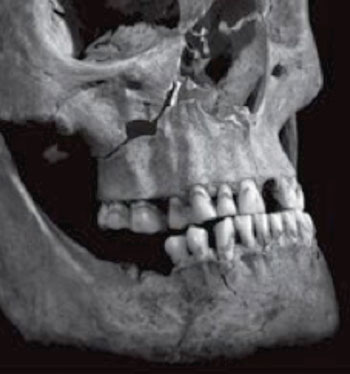 Image: Facial skeleton digital photograph; arrow shows the penetrating injury to the maxilla (Photo courtesy of the Lancet).
