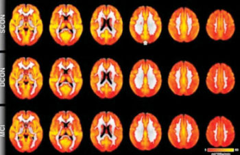 Image:  Brain perfusion: Red indicates low perfusion, yellow indicates high perfusion. Overall, the brain perfusion is similar between all three groups (see article). The most prominent difference is present in the posterior cingulate cortex (indicated by the arrow), a region close to the midline in the superior and posterior part of the brain. Control participants who remain stable have higher perfusion as compared to deteriorating controls and MCI (Photo courtesy of RSNA the Radiological Society of North America).
