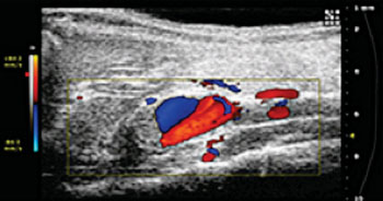 Image: Purdue University researchers are using ultrasound images like this one to study abdominal aortic aneurysms, a potentially fatal condition that is the 13th leading cause of death in the United States (Photo courtesy of Purdue University/Weldon School of Biomedical Engineering).