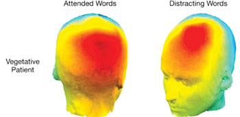 Image: This scan depicts patterns of the vegetative patient’s electrical activity over the head when they attended to the designated words, and when they when they were distracted by novel but irrelevant words (Photo courtesy of clinical Neurosciences).