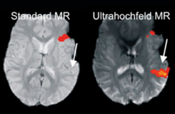 Image: Ultra-high-field MRI reveals language centers in the brain in much more detail (Photo courtesy of Medical University of Vienna).