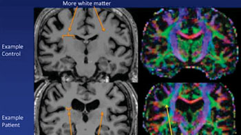 Image: Example of an MR image of a control subject’s brain on top and a chronic fatigue brain on bottom. The ventricles are larger in the chronic fatigue syndrome patient, and there is less white matter. Abnormal microstructure is present on one side in the white matter in chronic fatigue syndrome (Photo courtesy of Michael Zeineh, Stanford University).