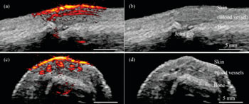 Image: Photoacoustic/ultrasound images taken with the new system show a human finger joint from different angles. The images on the right (b and d) show anatomic structures revealed by the ultrasound. The images on the left (a and c) show the photoacoustics data overlaying the ultrasound data. The bright yellow and red at the top of the finger show the skin and blood vessels running parallel to the finger (Photo courtesy of Pim van den Berg/Khalid Daoudi).