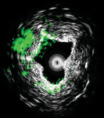 Image:  A new type of medical imaging technology could diagnose cardiovascular disease by measuring ultrasound signals from molecules exposed to a fast-pulsing laser. The system, called intravascular photoacoustic imaging, takes precise three-dimensional images of plaques lining arteries and identifies deposits that are likely to rupture and cause heart attacks. This cross-sectional view of an artery shows lipids (green) deposited inside the arterial wall. Black and white indicate contrast showing the cross-sectional geometry (Photo courtesy of Purdue University).