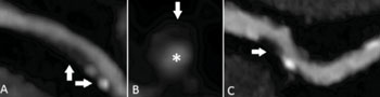 Image: Coronary CT angiography images demonstrate examples of high-risk plaque features. A, Image was obtained in a 63-year-old man with partially calcified plaque, positive remodeling (vertical arrow), and spotty calcium (horizontal arrow). B, A cross-sectional view of a noncalcified plaque in a 65-year-old man demonstrates a napkin-ring sign with a central low-attenuation area, surrounded by a peripheral rim of higher attenuation (arrow) next to the lumen (∗). C, Image in a 60-year-old woman with partially calcified plaque demonstrates a low CT number in the midportion (arrow) (Photo courtesy of the journal Radiology).