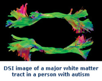 Image: MR diffusion spectrum imaging (DSI) used to examine the structural integrity of white matter in people with autism and typical participants. These imaging techniques visualize axonal tracts by measuring the diffusion of water along white matter fibers (Photo courtesy of Center of Cognitive Brain Imaging, Carnegie Mellon University).