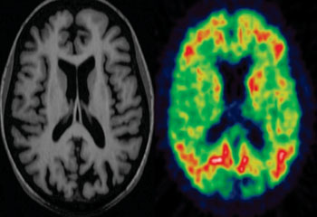 Image: MRI and PET scans of a patient with dementia (Photo courtesy of Dr. Paul Edison, neurology imaging unit, Imperial College London’s Imanova  International Translational Imaging Center).