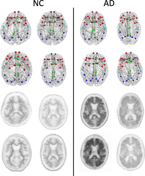 Image: Structural connectomes (top two rows) and corresponding florbetapir PET images (bottom two rows) in four patients with normal cognition (NC) with the lowest whole cortex amyloid burden (left) and the four patients with AD with the highest whole cortex amyloid burden (right) focused on the composite regions used in connectome versus amyloid analysis. Nodes represent the centroids of the FreeSurfer parcellations in the frontal (red), cingulate (green), temporal (light blue), and parietal (dark blue) regions. This is only a schematic intended to show the concepts and is not intended to show any visually discernible generalizable difference between the patients with NC and those with AD. Structural network metrics provide more sensitive information about the connectome than are apparent through visualization alone (Photo courtesy of RSNA).