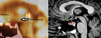 Image: PET/CT on the left and an MRI on the right demonstrating the relative locations of both the hypothalamus and the pituitary (Photo courtesy of RSNA).