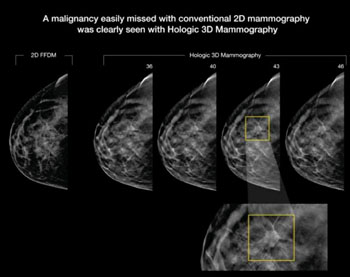 Image: A tumor that easily missed on 2-D mammography was clearly seen on 3-D mammography (Photo courtesy of RSNA).