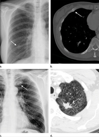 Image: Examples of lesions seen on chest radiographic images that prompted a recommendation for chest CT examination and the corresponding abnormality on chest CT. (a, b) In the first example, a nodular opacity (arrow on a) is seen projecting over the right posterior ninth rib in the chest radiographic image of a 50-year-old woman who presented with cough; the recommended chest CT examination demonstrated this to be callus from a remote rib fracture (arrow on b). (c, d) In the second example, a nodular opacity (arrow in c) is seen projecting over the left anterior first rib on the chest radiographic image of a 53-year-old man who is a former smoker and presented with cough; the recommended chest CT examination demonstrated this to be a suspicious nodule in the apicoposterior segment of the left upper lobe (arrow in d). On resection, this was found to be well-differentiated adenocarcinoma of the lung (Photo courtesy of RSNA).