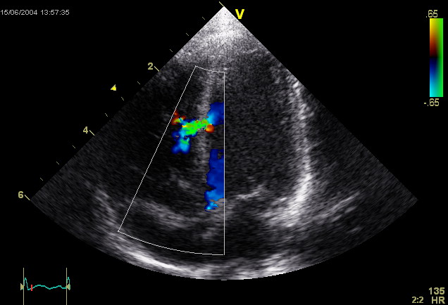 Image: An abnormal Echocardiogram. Image shows a mid-muscular ventricular septal defect. The trace in the lower left shows the cardiac cycle and the red mark the time in the cardiac cycle that the image was captured. Colors are used to represent the velocity and direction of blood flow (Photo courtesy of Wikipedia).