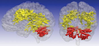 Image: Using an MRI technique that is sensitive to certain byproducts of cell metabolism, including levels of glucose and acidity, University of Iowa researchers discovered previously unrecognized differences in the brains of patients with bipolar disorder. The T1rho MRI scans showed brain regions of elevated signal in the 15 participants with bipolar disorder compared to the 25 participants who did not have bipolar disorder. The primary regions of difference are the cerebral white matter (yellow) and the cerebellum (red) (Photo courtesy of the University of Iowa).