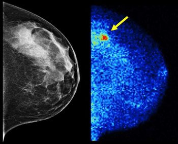 Image: Molecular Breast Imaging (right) detected 3.6 times as many invasive cancers as digital mammography (left) in the latest study of more than 1,500 women with dense breast tissue. About half of screening-age women have dense breast tissue, which digital mammography renders the same whitish shade as tumors. Results are published in the American Journal of Roentgenology (Photo courtesy of the Mayo Clinic / AJR).