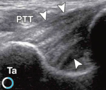 Image: Dynamic High-Resolution US of Ankle and Midfoot Ligaments: Normal Anatomic Structure and Imaging Technique (Photo courtesy of RadioGraphics Journal).