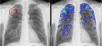Image: Small lesion in the upper right lobe (left), and corresponding detection by the CAD system (right) (Photo courtesy of Radboud UMC).