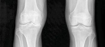 Image: New Possibilities for Osteoarthritis Detection Uncovered by Sackler Team (Photo courtesy of United States National Institute of Arthritis and Musculoskeletal and Skin Diseases (NIAMS)).