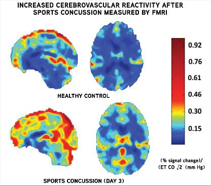 Image: Increased Cerebrovascular Reactivity after Sports Concussion Measured by FMRI (Photo courtesy of UPMC).