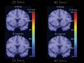 Image: Brain scan showing the how men and women respond differently during cigarette addiction (Photo courtesy of Yale News).