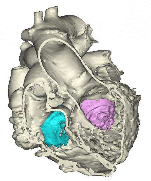 Image: 3-D Model of the Heart (Photo courtesy of Materialise).