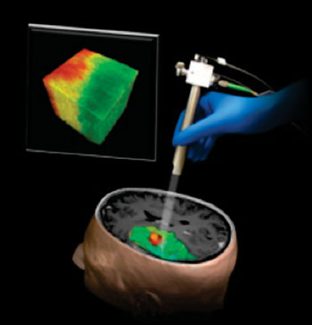 Image: Illustration of a new technique using Optical Coherence Tomography that could help surgeons differentiate a human brain tumor, red, from surrounding noncancerous tissue, green (Photo courtesy of  Carmen Kut, Jordina Rincon-Torroella, Xingde Li and Alfredo Quinones-Hinojosa/Johns Hopkins Medicine).
